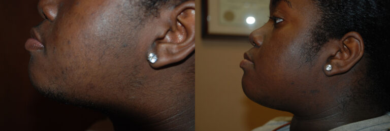 Laser Hair Removal Before and After photo by Radiansia, Total Aesthetic Solutions in Bloomfield, CT