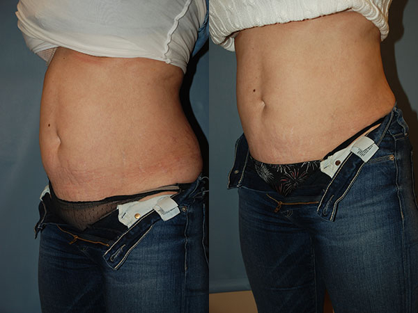 SculpSure Before and After photo by Radiansia, Total Aesthetic Solutions in Bloomfield, CT