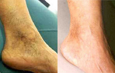 Spider Vein Treatment Before and After photo by Radiansia, Total Aesthetic Solutions in Bloomfield, CT