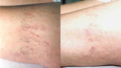 Spider Vein Treatment Before and After photo by Radiansia, Total Aesthetic Solutions in Bloomfield, CT