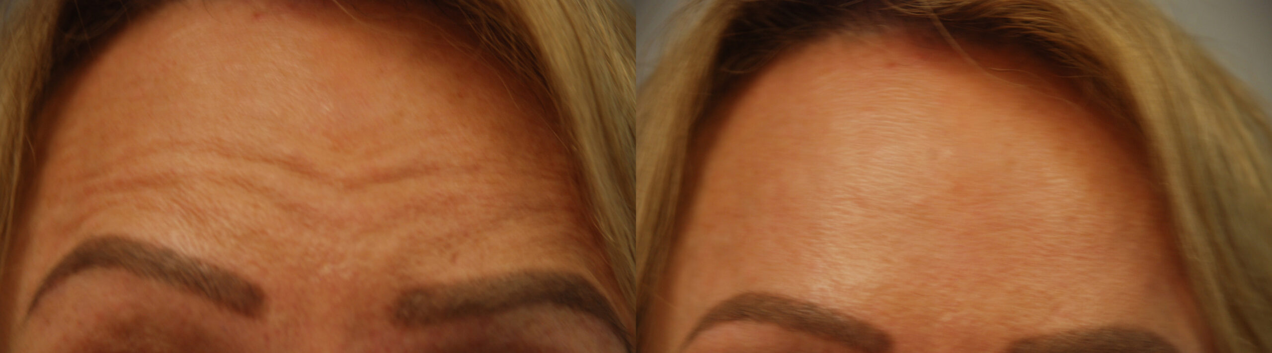 Botox® Before and After photo by Radiansia, Total Aesthetic Solutions in Bloomfield, CT