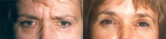 Botox® Before and After photo by Radiansia, Total Aesthetic Solutions in Bloomfield, CT