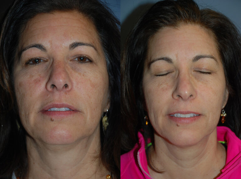 Photorejuvenation Before and After photo by Radiansia, Total Aesthetic Solutions in Bloomfield, CT