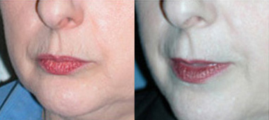 Facial Wrinkle Fillers Before and After photo by Radiansia, Total Aesthetic Solutions in Bloomfield, CT