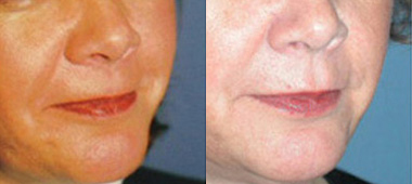 Facial Wrinkle Fillers Before and After photo by Radiansia, Total Aesthetic Solutions in Bloomfield, CT