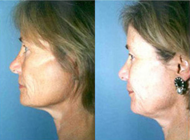 Photorejuvenation Before and After photo by Radiansia, Total Aesthetic Solutions in Bloomfield, CT