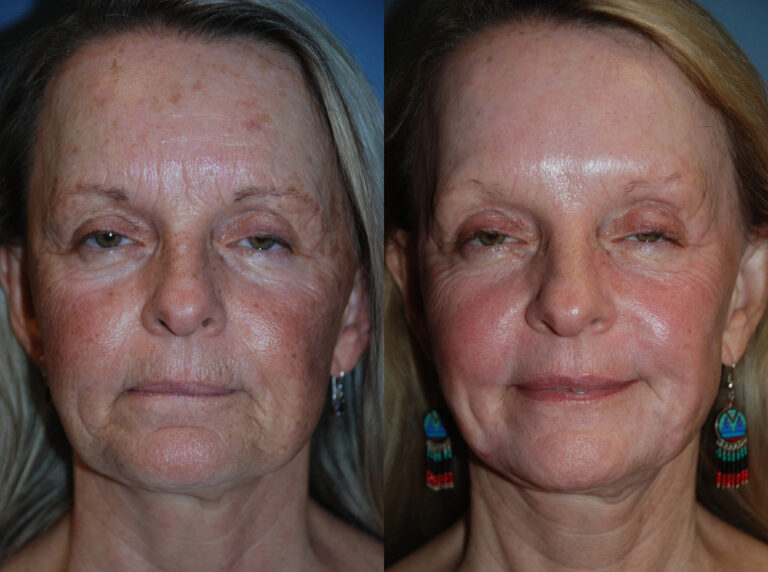 Skin Resurfacing Before and After photo by Radiansia, Total Aesthetic Solutions in Bloomfield, CT