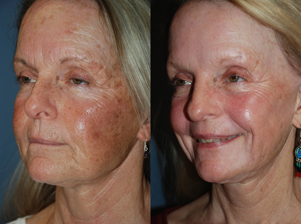 Skin Resurfacing Before and After photo by Radiansia, Total Aesthetic Solutions in Bloomfield, CT